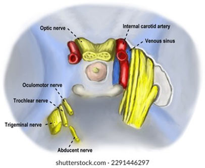 גידול בקברנוס סינוס - CAVERNOUS SINUS