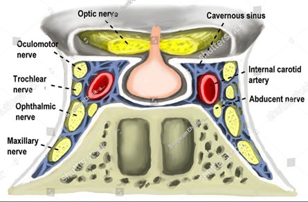 גידול בקברנוס סינוס - CAVERNOUS SINUS