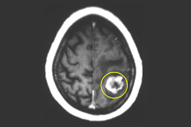 טיפול בגידולים ממאירים